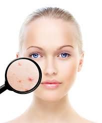 anti acne treatment