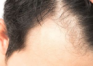 Alopecia Areata Treament