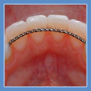 Bonded Retainer