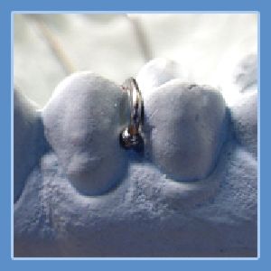 Ball Ended Dental Clasps