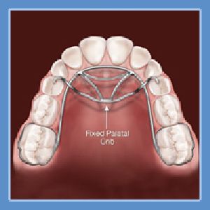 Thumb Sucking Habit Breaking Appliance Dental