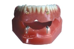 Telescopic Crowns