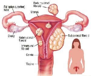 Fibroid Treatment
