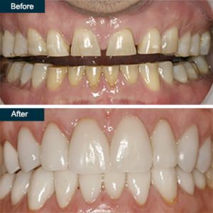 dental veneers treatment