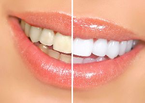 teeth whitening treatment