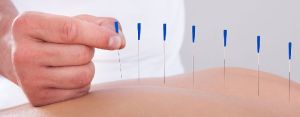 Dry Needling Therapy