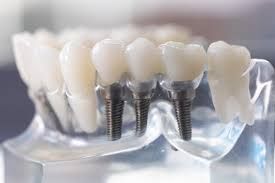 Dental Implants