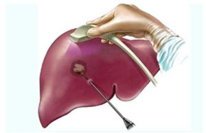 radio frequency ablation