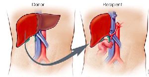 Liver Transplant Service