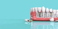 dental implant services