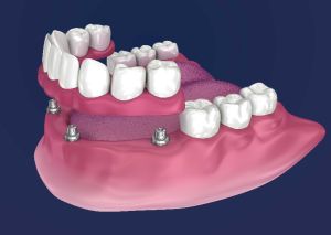 Overdenture Treatment Services