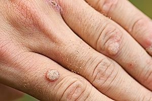 WART REMOVAL