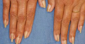 Nail Disorders Treatment