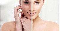 skin whitening treatment