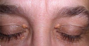 Xanthelasma Palpebrarum Treatment