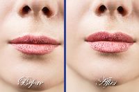 Lip Reduction Services