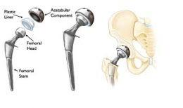 Total Hip Replacement Surgery