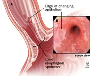 Heartburn (GERD & Hiatus Hernia)