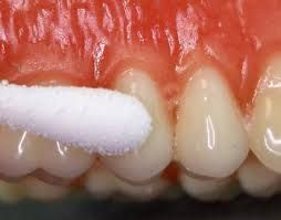 Bleeding Gums Treatment Services