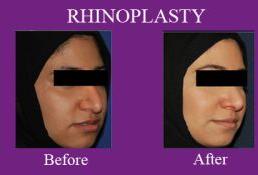 Rhinoplasty Surgery