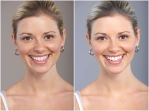 Smile Makeover Treatment Services