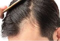 Ctrl+Z Hair loss Treatment