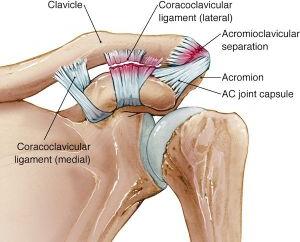 Arthritis and AC Joint Dislocation Treatment Surgery