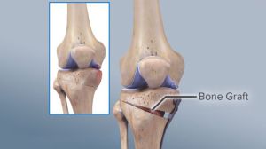 osteoarthritis treatment