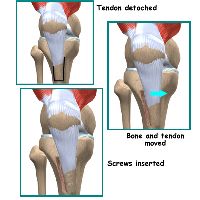 Patella Dislocation Treatment