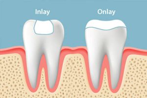 Inlay Onlay Dental Treatment Services