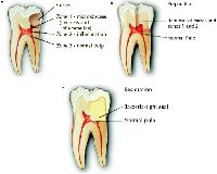 Pulp Capping