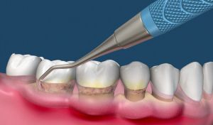 Sub Gingival Scaling