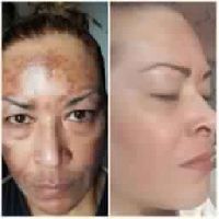 Melasma Treatment