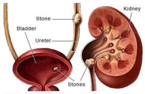 Kidney Stone Treatment