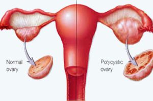 Polycystic Ovarian Syndrome Treatment