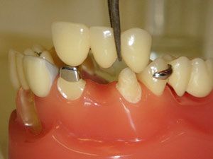 Crowns and Bridge Dentistry Treatment Services