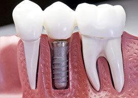 Dental Implant Treatment Services