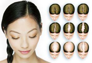 Female Pattern Baldness (Female Hair Loss)