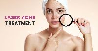 Laser Acne Treatment in Gurgaon
