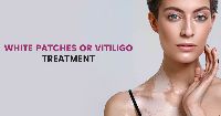 White Patches Treatment in Gurgaon