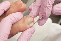 Ingrown Toenail Treatment in Kolkata