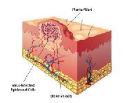 Verruca Treatment