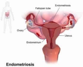 Endometriosis Treatment Services