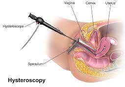 Hysteroscopy Surgery Treatment Service