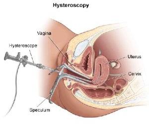 Hysteroscopy Treatment