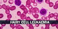 Hairy Cell Leukemia Treatment in India