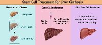 Liver Cirrhosis Treatment in India