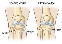 Osteotomy in India