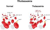 Thalassemia Treatment In India