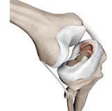 Meniscal Tear Treatment Services